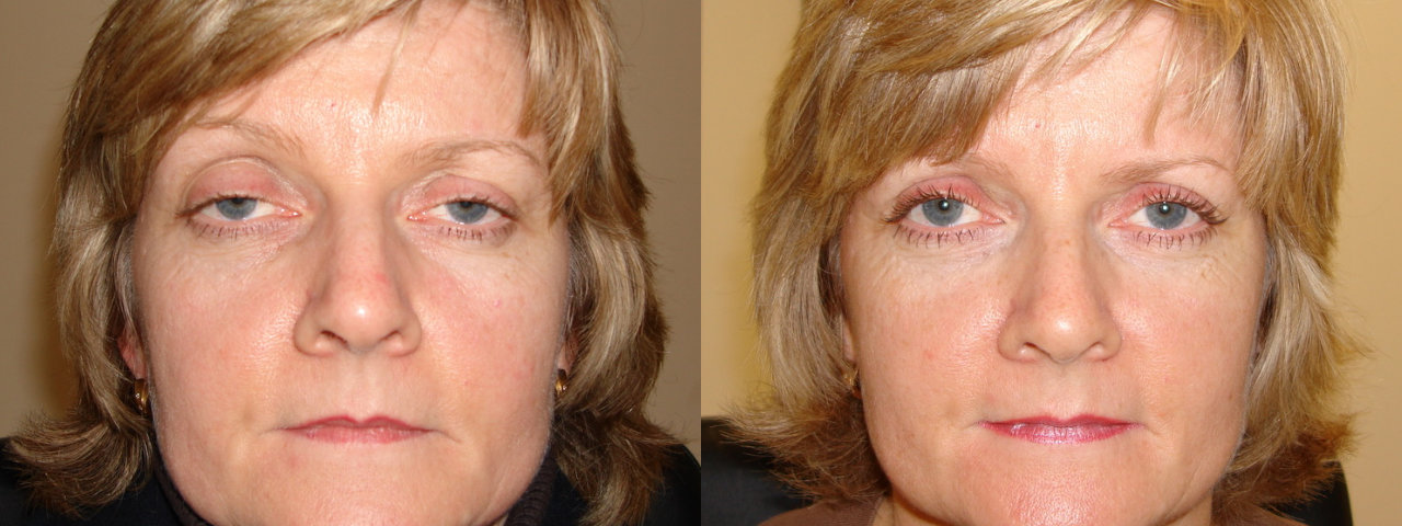 Ptosis - Before and After Treatment